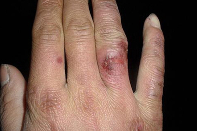 冻疮手指症状图