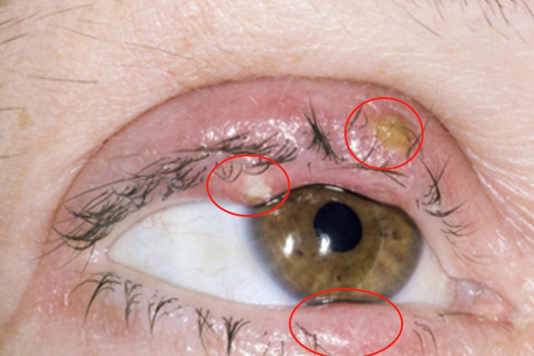 睑板腺癌眼睑肿图 睑板腺癌眼睑肿图