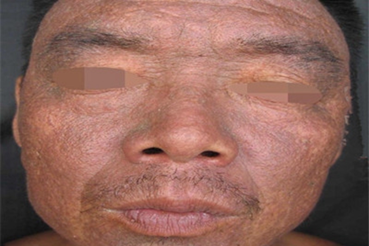 毛囊角化病面部症状图片