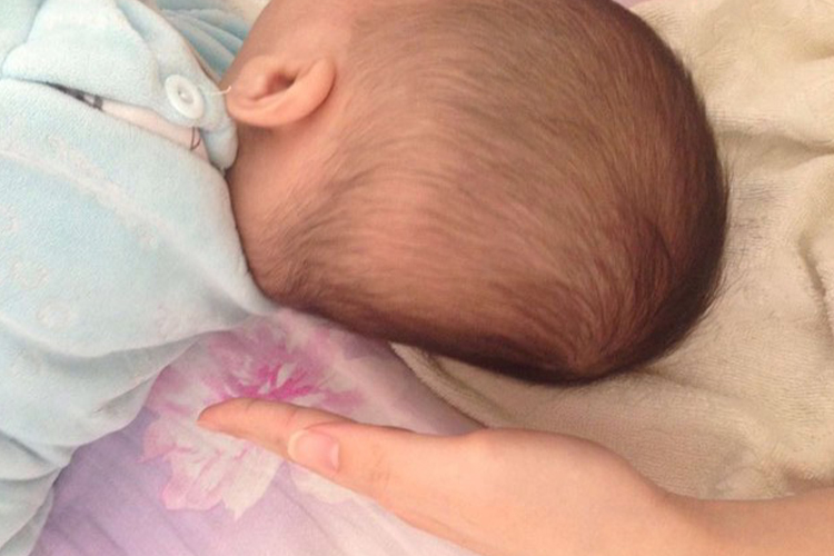 婴儿头型后脑勺异常图