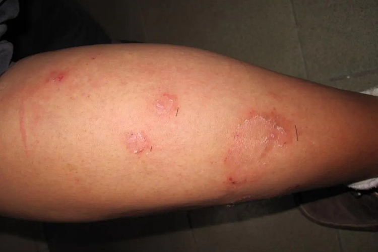 糖尿病患者体癣图