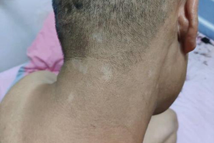 特发性点状色素减退斑后颈症状图