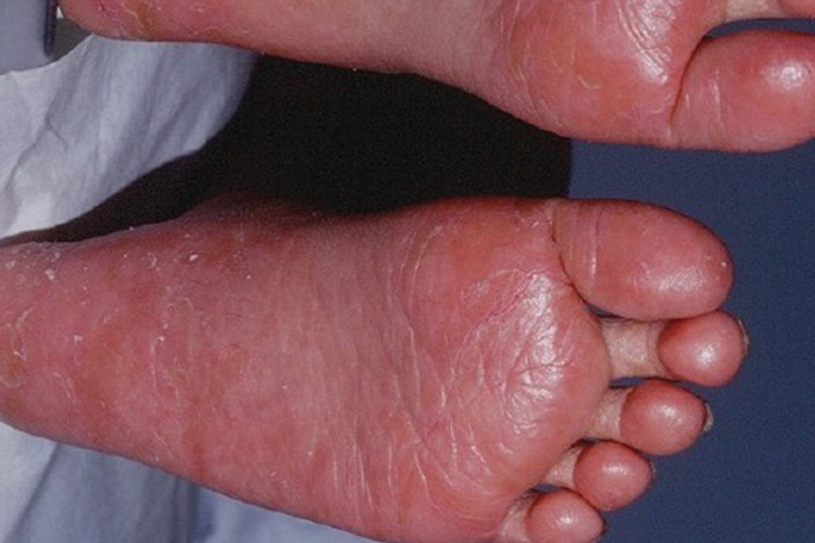 足底红皮病型银屑病图