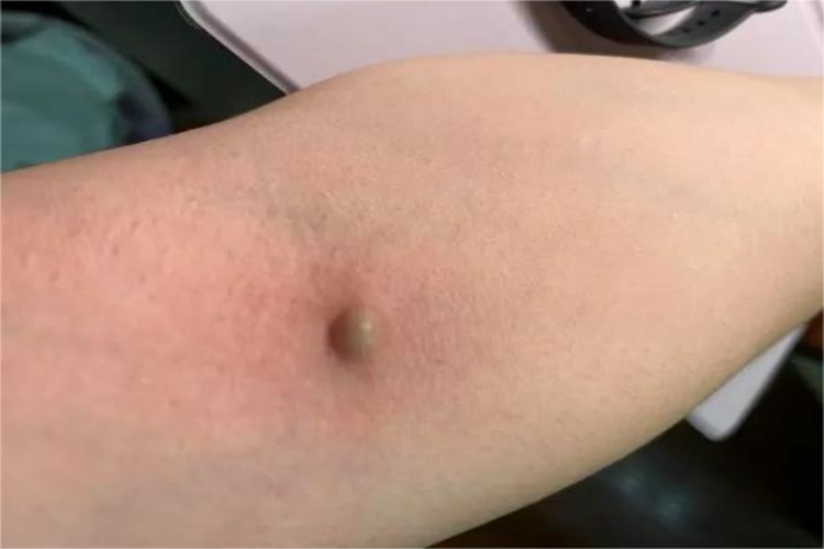 手臂皮脂腺囊肿图