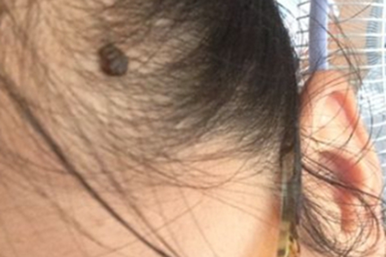 良性幼年黑素瘤头皮黑痣图