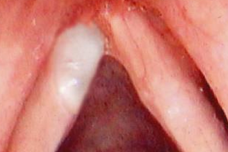 小孩喉接触性溃疡图