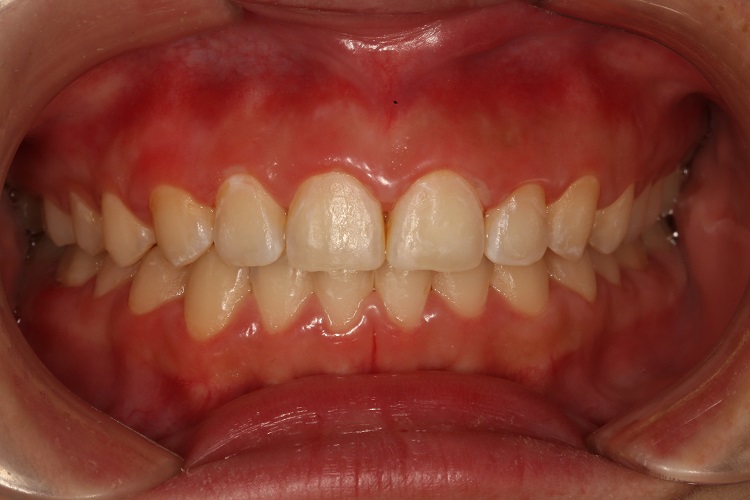 深覆(牙合)牙齿前突图 深覆(牙合)牙齿前突图