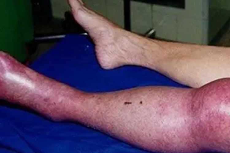 淋巴水肿小腿皮肤发紫图