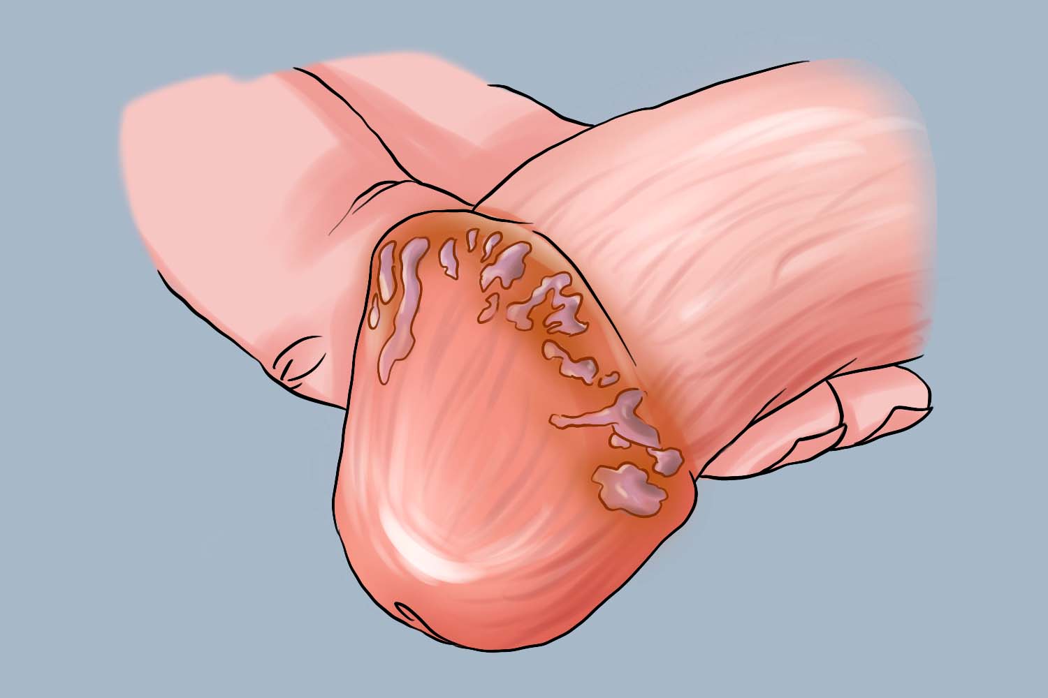 环状溃烂性包皮龟头炎图