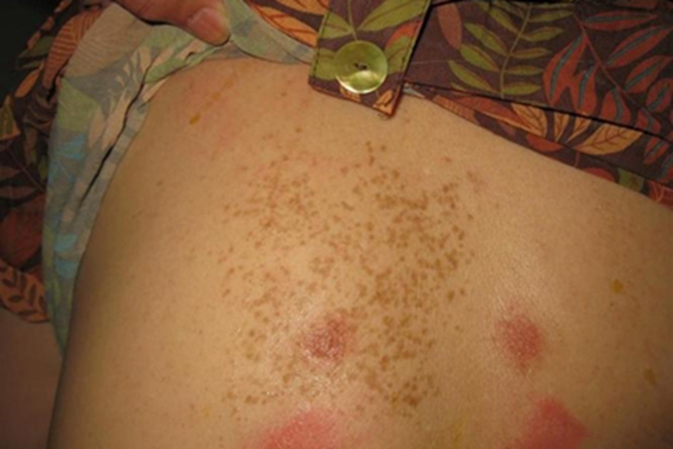 日光性雀斑样痣腰部长斑图 日光性雀斑样痣腰部长斑图