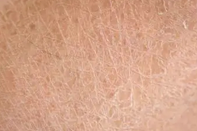 冬季瘙痒症皮肤裂纹图