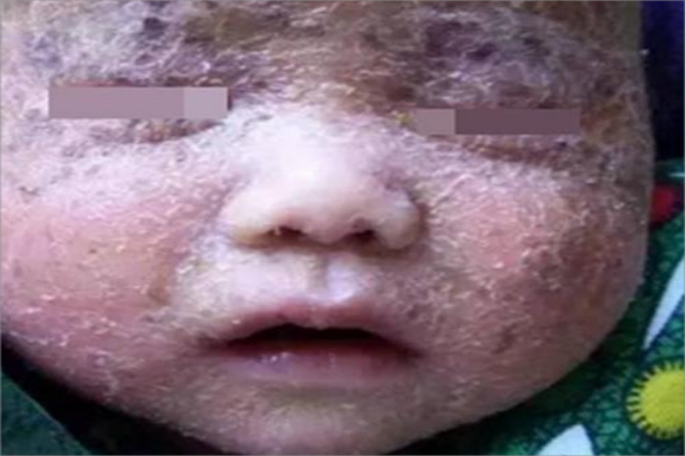 火棉胶婴儿面部脱屑图 火棉胶婴儿面部脱屑图