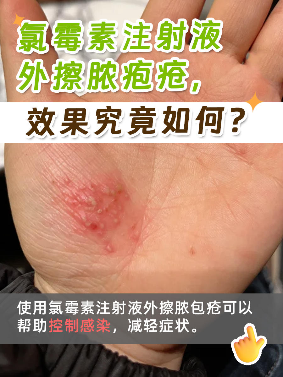 氯霉素注射液外擦脓疱疮，效果究竟如何？