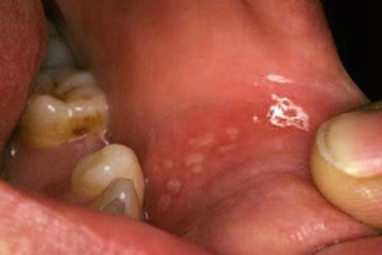 创伤性溃疡唇内侧症状图