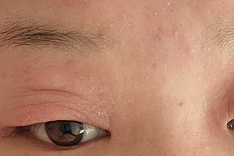 皮肤过敏眼睑红肿症状图