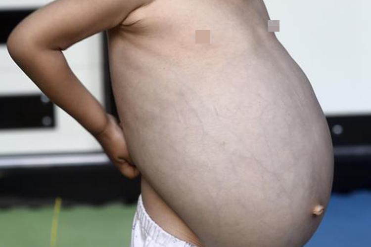 小男孩大肚子病图 小男孩大肚子病图