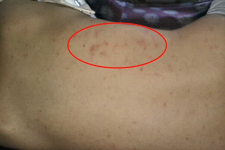 结痂性疥疮红斑图 结痂性疥疮红斑图