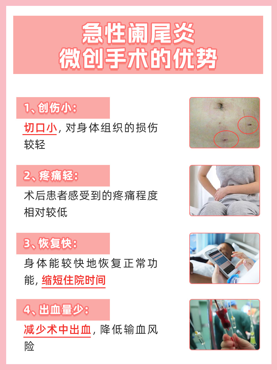 急性阑尾炎微创术后,几天能出院?一文解析
