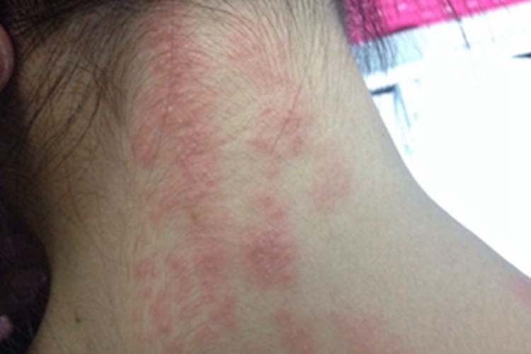 皮肤过敏红肿后颈症状图 皮肤过敏红肿后颈症状图