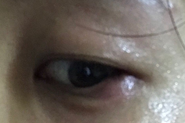 外眼睑炎眼尾发炎红肿图 外眼睑炎眼尾发炎红肿图