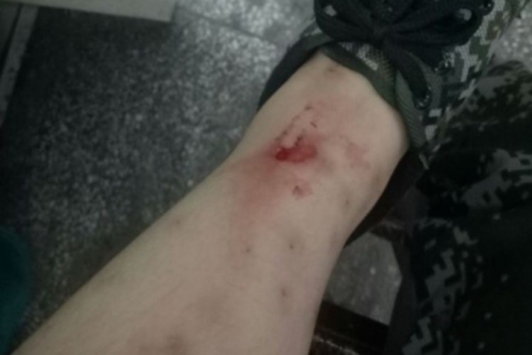 虫咬皮炎糜烂图 虫咬皮炎糜烂图