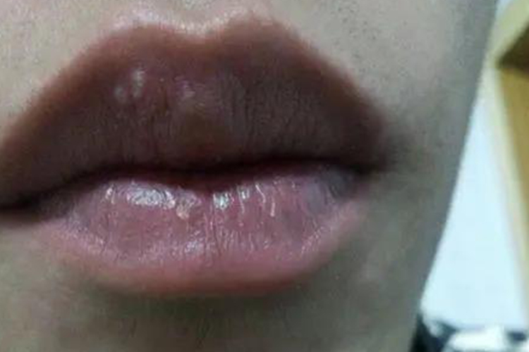 嘴唇上白疙瘩图 嘴唇上白疙瘩图