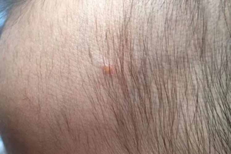 水痘头皮长一个小水疱图 水痘头皮长一个小水疱图