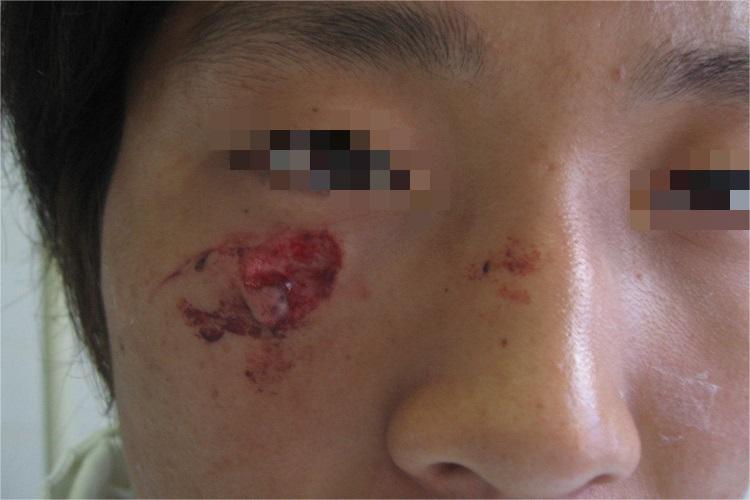 戳伤面部缺损图