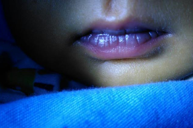 嘴唇青紫图 嘴唇青紫图