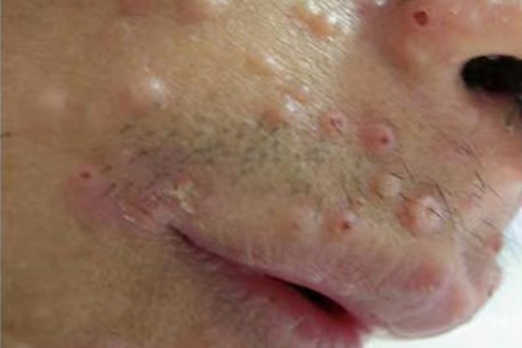 播散性马尔尼菲青霉病面部丘疹图