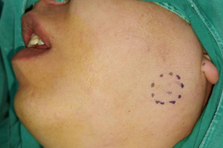 腮腺皮样囊肿症状图 腮腺皮样囊肿症状图