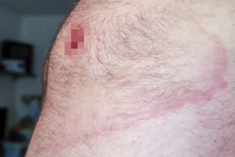 慢性游走性红斑胸部症状图