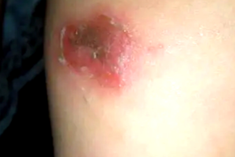 幼年型类天疱疮腿糜烂图