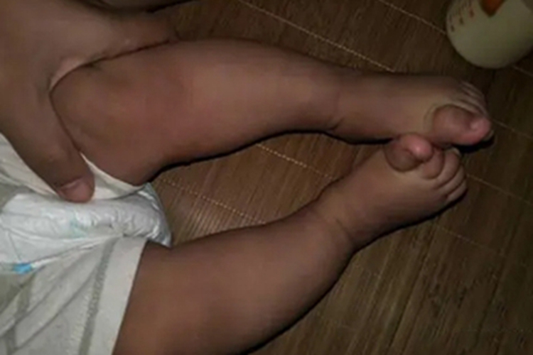 新生儿佝偻病症状图 新生儿佝偻病症状图