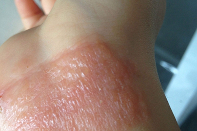 柯萨奇湿疹手腕症状图 柯萨奇湿疹手腕症状图