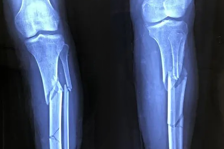 骨折X光图