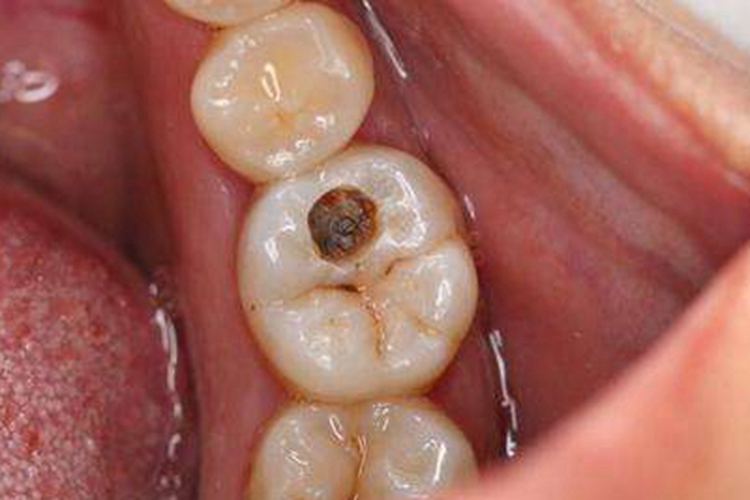 维生素D依赖性佝偻病症状图 维生素D依赖性佝偻病症状图