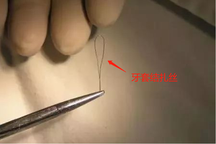 牙套结扎丝图 牙套结扎丝图