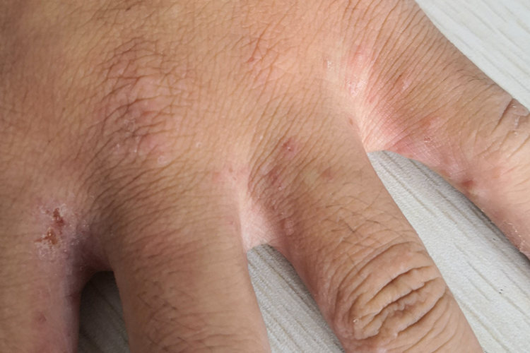 散在排列性丘疹