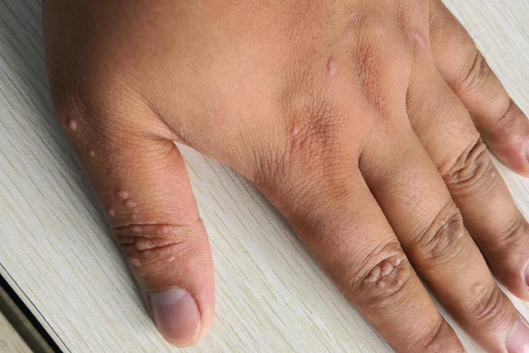 女性HPV感染手上扁平疣图 女性HPV感染手上扁平疣图