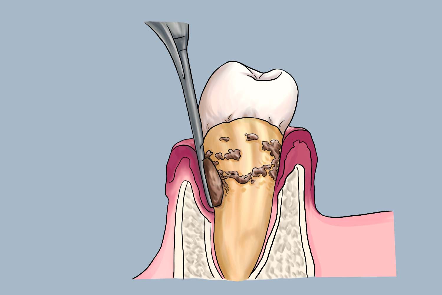 藏在牙龈里的牙结石图 藏在牙龈里的牙结石图