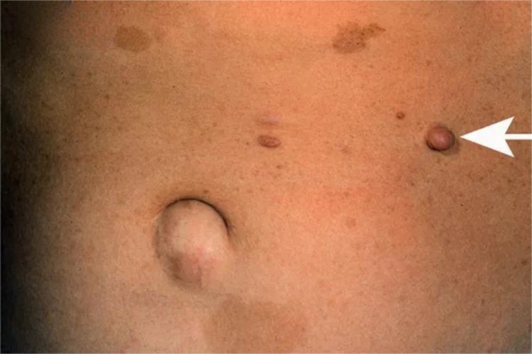 腰部神经纤维瘤图