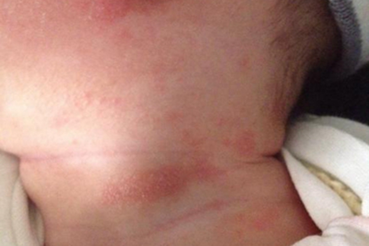 摩擦红斑症状图