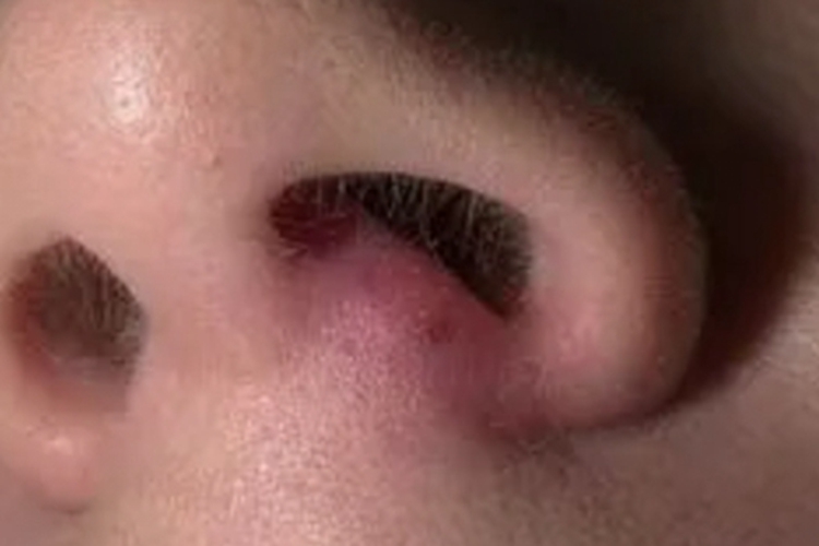 鼻疖疙瘩图 鼻疖疙瘩图