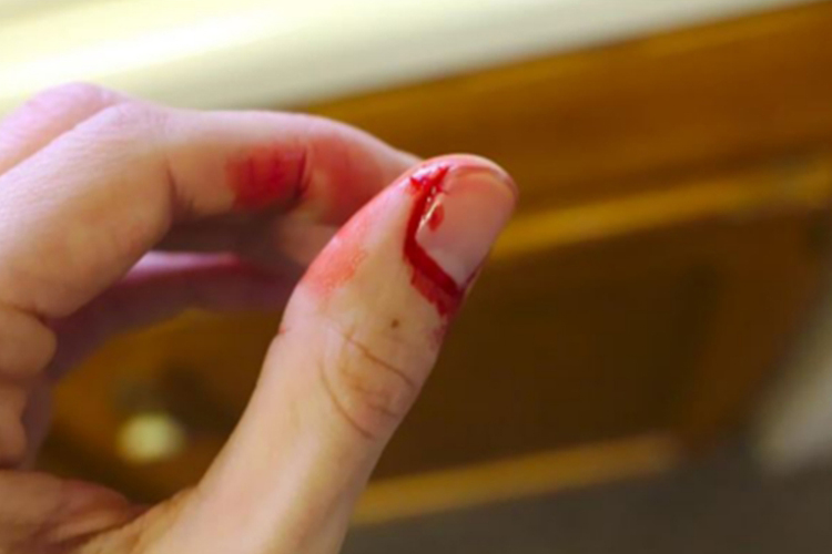 手部受伤流血图