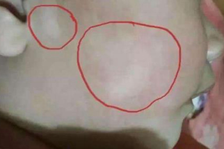 蛔虫病面部白斑图 蛔虫病面部白斑图