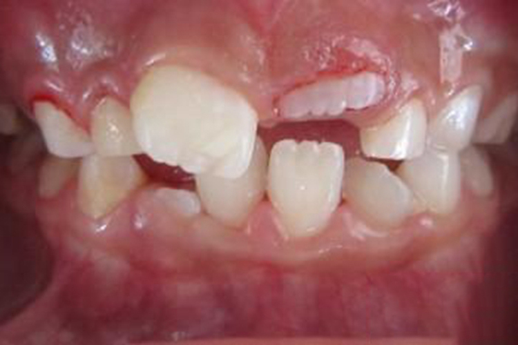 切龈助萌术切口图