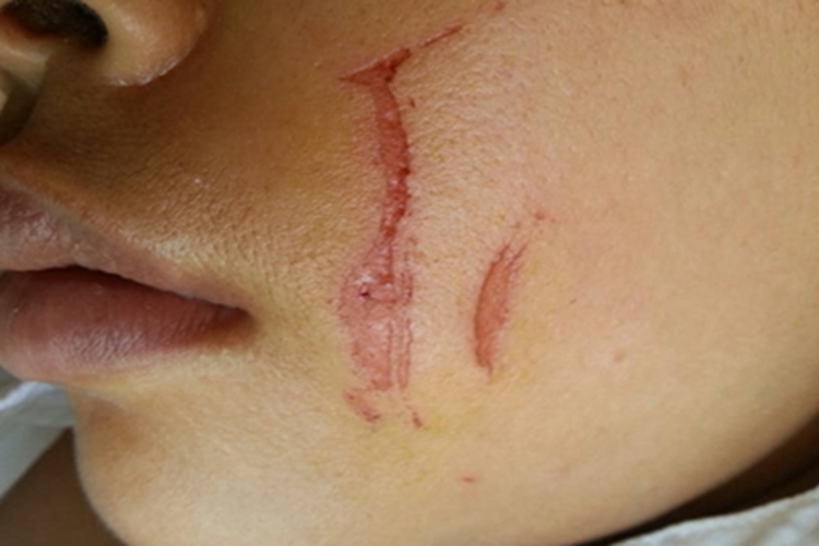 抓伤面部疤痕图