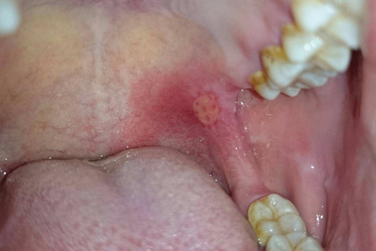 复发性阿弗他溃疡水肿图