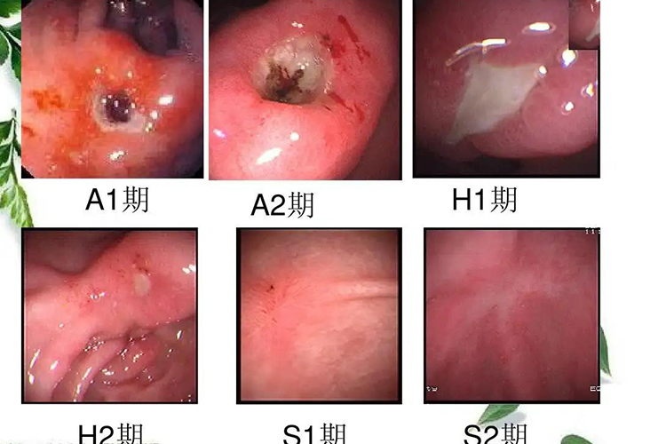 溃疡分期三期六段多图 溃疡分期三期六段多图